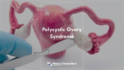 polycystic ovaries tagalog